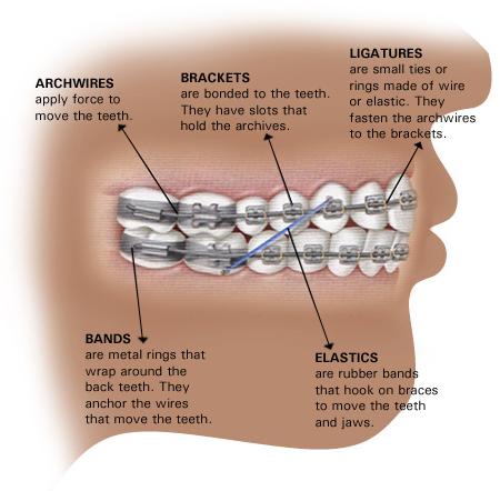 What is Ligature Wire for Adult Braces?