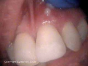 tooth abscess