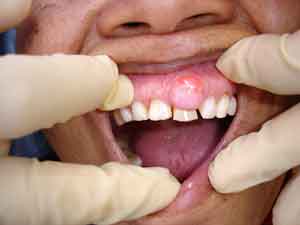 abscess tooth