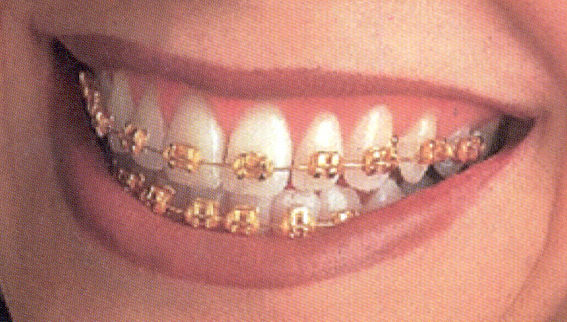Brackets Dental