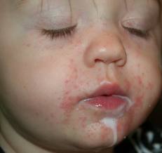 What is causing the rash around my toddler's mouth, and ...
