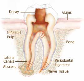 Root Canal Infection