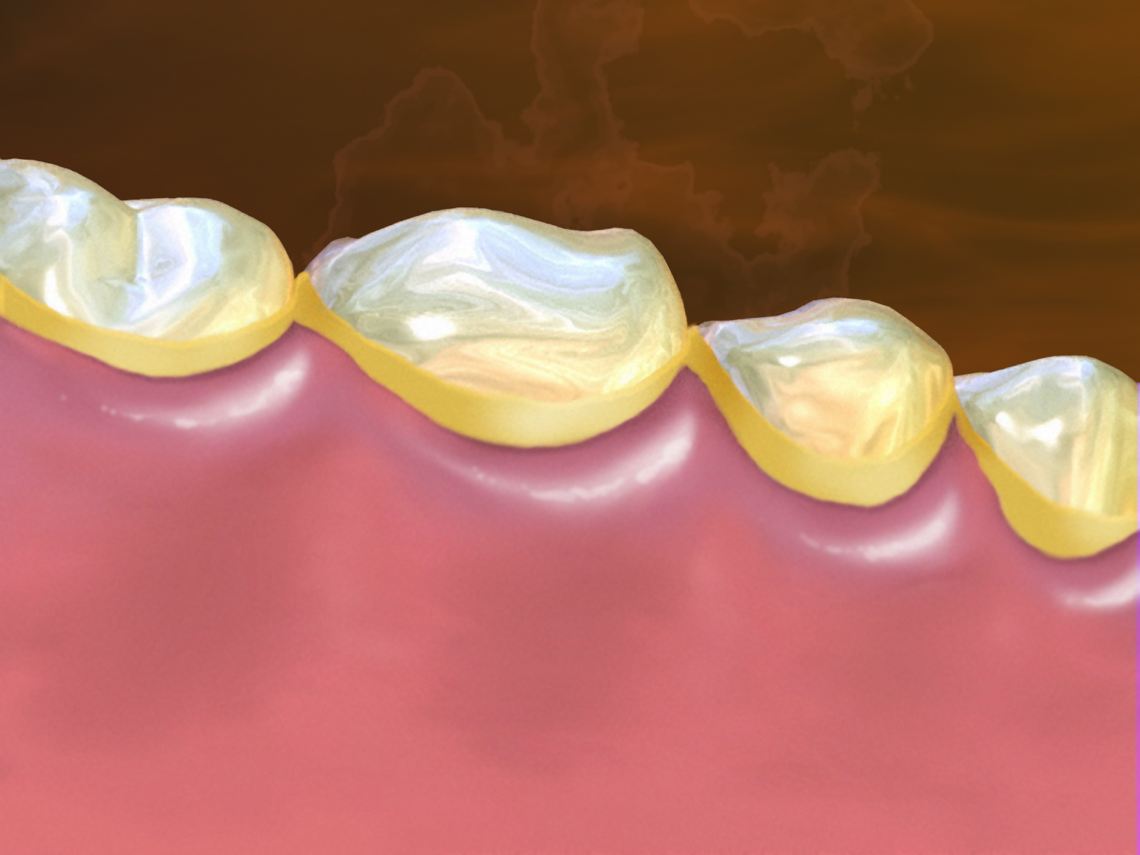 Healthy+gums+vs+gingivitis