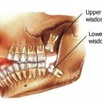 Impacted teeth