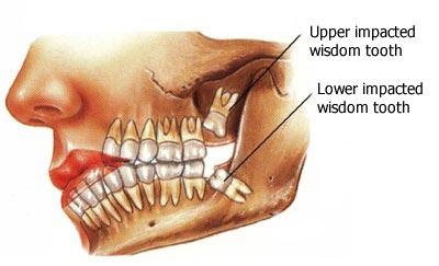 What causes nerve pain in teeth?