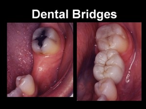 bridge dental bridges cost advantages mouth teeth disadvantages tooth crown implants intelligentdental