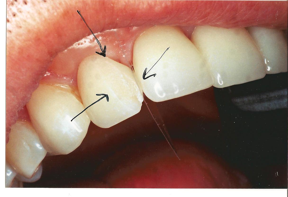 do porcelain veneers ruin teeth