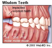 wisdom teeth extraction dangers