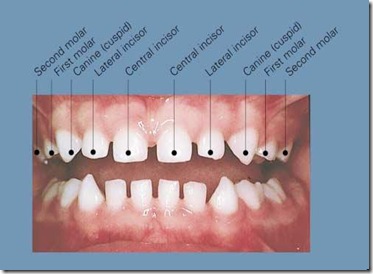 human with 3 sets of teeth