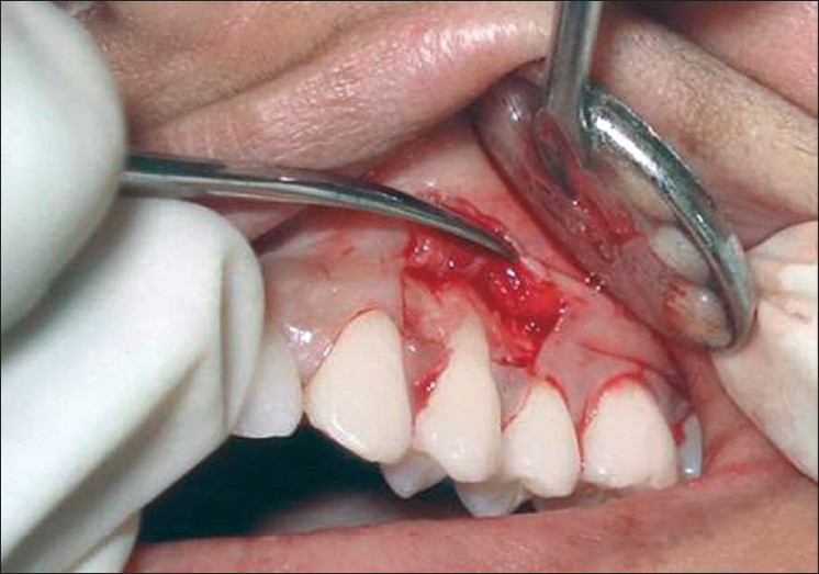 Tissue Flap Classification: Classification and Principles ...