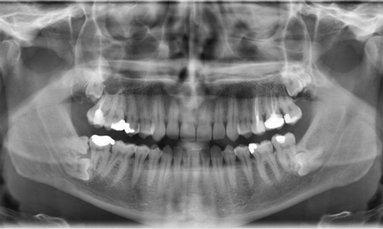 Indications of different types of extraoral radiograph Part 2