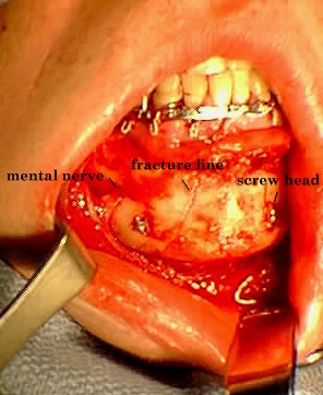 What causes nerve pain in teeth?