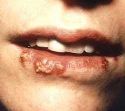 Cold Sores Herpes Genital