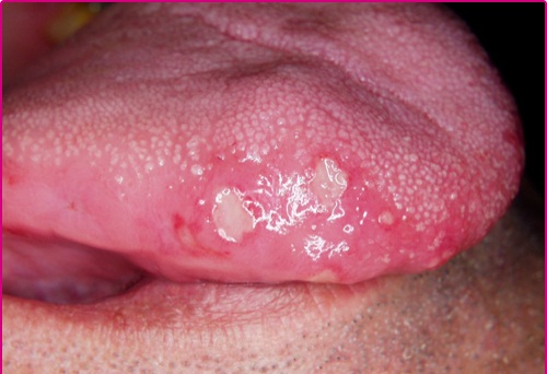 herpes tongue picture - Top Doctor Insights on HealthTap