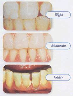 causes tartar your teeth