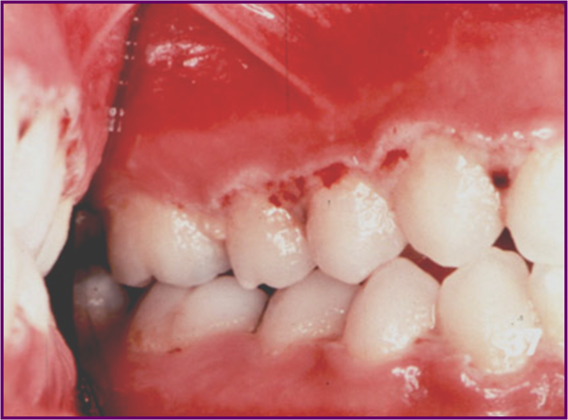Bacterial infection in mouth discount