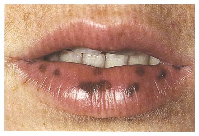 oral melanotic macule #10