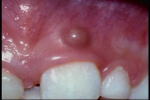 abscess gum