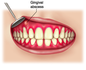 Root Canal