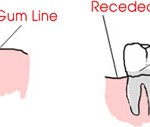 Dentine Hypersensitivity