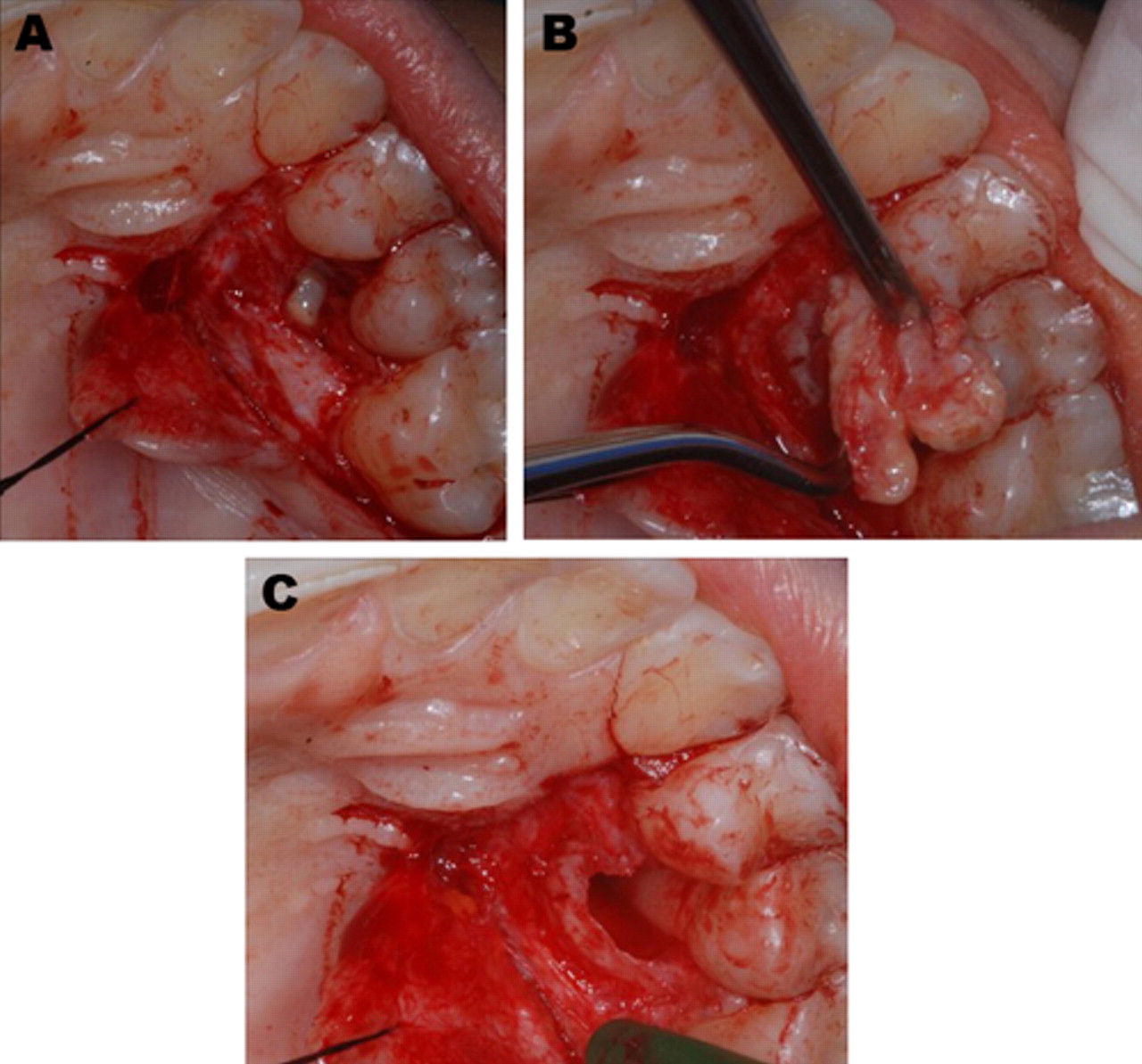 Oral Cyst Removal 82