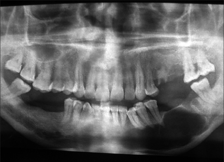 Cysts Of The Jaw Part 2 Intelligent Dental