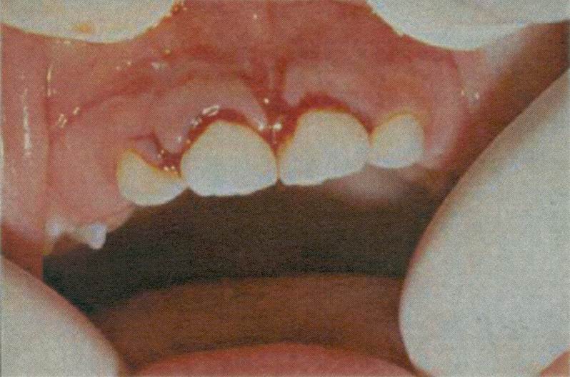 treatment delayed eruption teeth