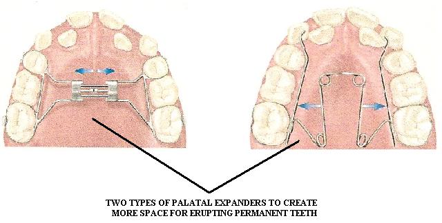 expander palate expanders palatal orthodontic different tooth kinds dental braces children appliance correction eruption dates williams re why