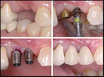 Dental Implants For Children