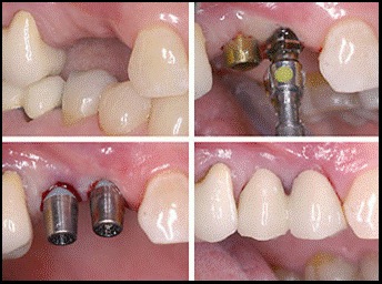 Dental Implants