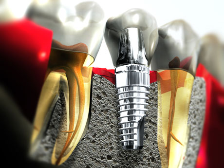 About Dental Implants Part 1 | Intelligent Dental