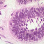 Histopathological view of acanthomatous ameloblastoma
