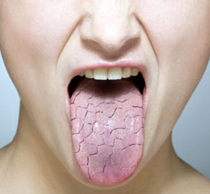 Dry Tongue Mouth 107