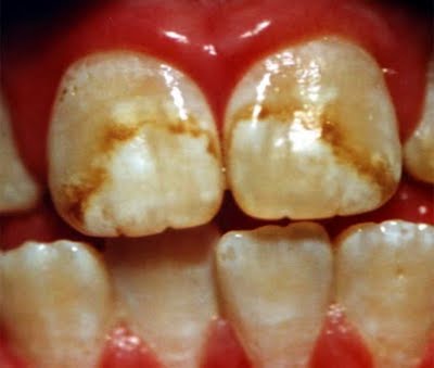 brownish discoloration of teeth