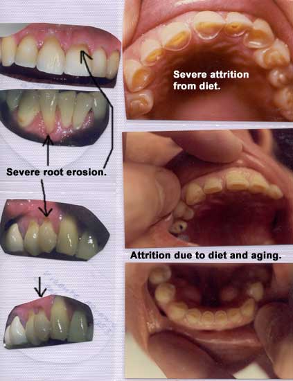 erosion of teeth definition