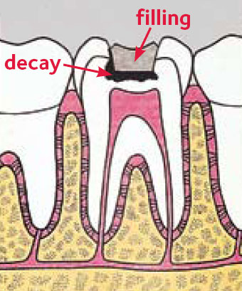 How long will pain last after a cavity is filled?