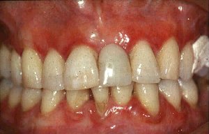 Swollen gums in gingivitis