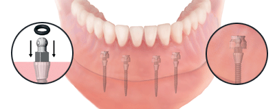 Special Housing and O rings for retrofitting the denture