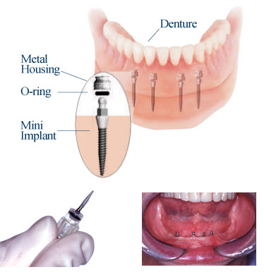 Mini dental implants.Image taken from http://www.intelligentdental.com/wp-content/uploads/2009/08/miniimp03.jpg