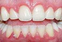 Gum disease    Picture courtesy of www.omgperio.ca/media/graphic/news_gingivitis.jpg