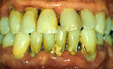 Chronic periodontitis.Image taken from 