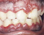 red and bleeding gum.Image is taken from http://www.softdental.com/diseases/Primary_Herpes_Simplex_HSV_Infection.html