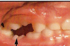 Submerged baby tooth @ orthodontics.org