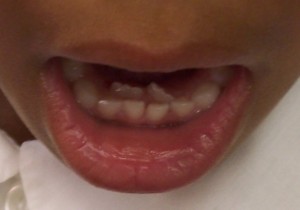 double teeth by denisebassallendds.com