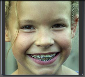 orthodontic treatment for children @ aligndoc.com