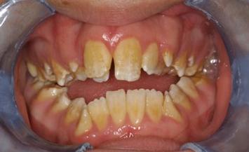 Yellow teeth stains from inherited conditon, amelogenesis imperfecta