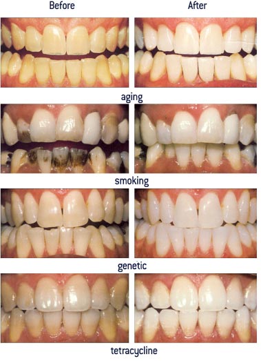 Tooth whitening results that can be achieved with Zoom teeth whitening system