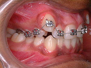 Orthodontic treatment of crowded teeth; the ca...