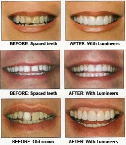 Before and after of dental veneer treatment @ websiteoptimization.com