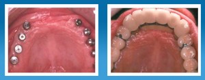 Before and after dental implant treatment for upper edentulous jaw @ 99dentalimplants.com